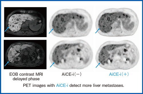 図15　病変検出におけるAiCE-iの効果 74歳，男性，転移性膵臓がん症例における肝転移の検出