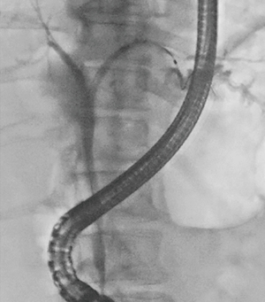 図12　症例1：左肝内胆管狭窄 パルス透視7.5fps