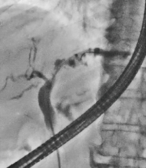 図13　症例2：胆管狭窄 パルス透視7.5fps 新画像処理条件
