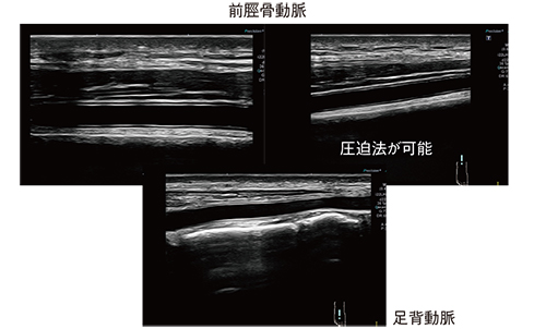図11　22MHzホッケー型リニアプローブによる前脛骨動脈および足背動脈のIMTの描出