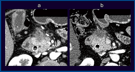 図2　症例1：浸潤性膵管がん，前方浸潤（＋）（40歳代，女性） a：MDCT（1mm） b：Aquilion Precision（1mm）