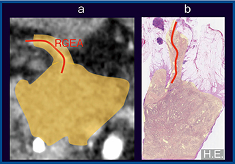 図3　症例2：浸潤性膵管がん，前方浸潤・神経叢浸潤（＋）（50歳代，女性） a：Aquilion Precision（1mm） b：病理像（H.E.）