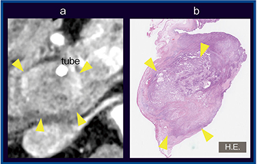 図6　症例5：肝門部領域胆管がん，術前評価（60歳代，男性） a：Aquilion Precision（軸位断1mm） b：病理像（H.E.）