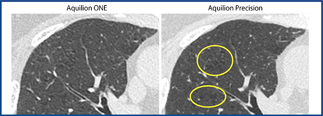 図4　Aquilion Precisionと従来機の胸部CTの違い（同一患者，共に1mm厚） Aquilion Precisionでは従来機では不鮮明な小葉中心性肺気腫が明瞭に描出される。