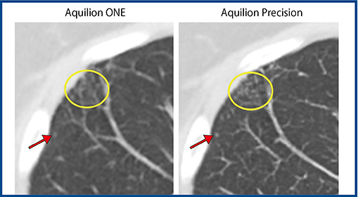 図5　5mm厚画像でのAquilion Precisionの描出能（同一患者，共に5mm厚） Aquilion Precisionでは微細な結節影や網状影が「ぼけることなく」描出される。