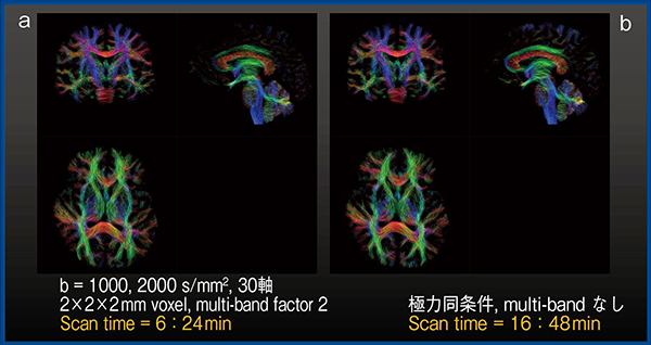 図1　拡散MRIにおける撮像時間の高速化 a：Vantage Galan 3T　b：少し前の世代のMRI装置 （以下，Vantage Galan 3Tのデータはすべて順天堂大学の装置にて撮像）