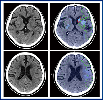 図3　頭部単純CTにおける早期虚血性変化の表示