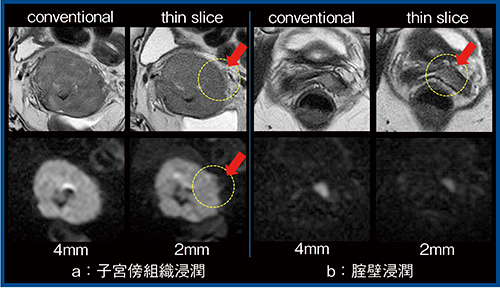 図1　AiCEを適用したthin slice image（子宮頸がん）
