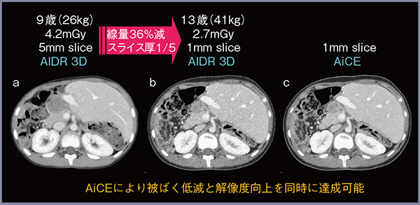 図1　胆道閉鎖症による生体肝移植後の女児