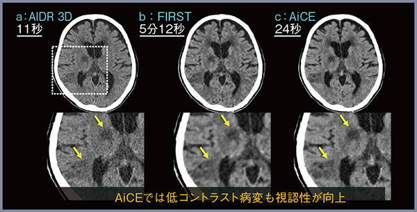 図2　急性期脳梗塞（低線量撮影）