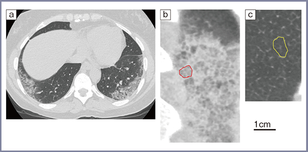 図2　60歳代，女性，COVID-19肺炎（2020年の症例）3） a：高精細CT軸位断像　b：病変部分の冠状断拡大像 c：正常部分の拡大像