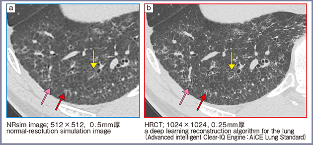 図5　30歳代，男性，NSIPのシミュレーション画像と高精細CTの比較
