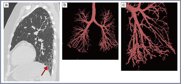 図6　50歳代，女性，関節リウマチに伴う間質性肺炎 a：高精細CT矢状断像　b：気管支3D画像　c：気管支3D画像の左肺の拡大像