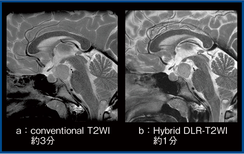 図1　視床下部過誤腫症例のT2WIにおけるconventionalとHybrid DLRの比較