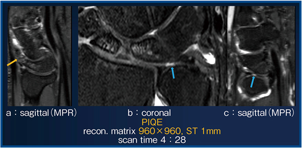 図3　月状骨骨折とTFCC損傷の症例におけるPIQE適用1mm・2D FS-PDWI画像