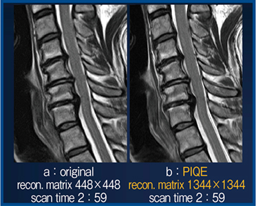 図4　頸椎椎間板膨隆とヘルニアの描出におけるPIQEの有無での画像比較