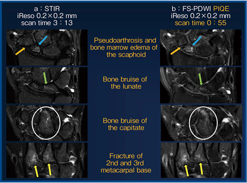 図5　短時間撮像のPIQEによる骨折や骨挫傷の描出