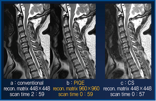 図6　短時間撮像におけるPIQEとCSの画像比較 （頸椎症，椎間板ヘルニア症例）