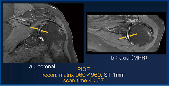 図7　PIQEによる高分解能化と短時間化の両立 （肩甲上腕関節の軟骨損傷疑い症例）