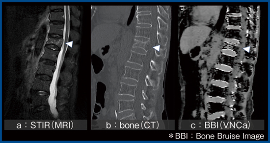 図3　VNCaを用いた骨折部位の判定（腰椎圧迫骨折疑い） VNCa（c）では，髄内血腫（◁）が描出されている。