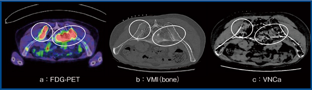 図4　VNCaを用いた転移性骨腫瘍の検出