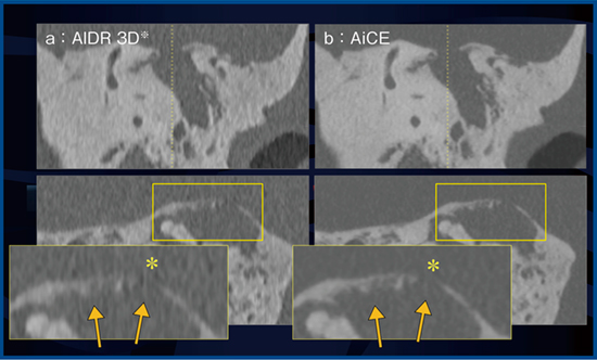 図3　真珠腫性中耳炎の進展例（77歳，男性） →：病変が側頭骨天蓋部分の骨を腐食し，頭蓋底の欠損（＊）を来している。 ※Adaptive Iterative Dose Reduction 3D：AIDR 3D
