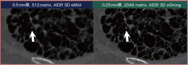図2　間質性肺炎におけるびまん性肺骨化症の検出 （参考文献5）より引用転載） Adaptive Iterative Dose Reduction 3D：AIDR 3D