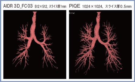 図3　PIQEによる気管支の自動抽出の精度向上