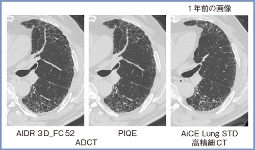 図5　間質性肺炎：ADCTと高精細CTの比較