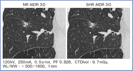 図2　肺条件におけるNRモードとSHRモードの比較