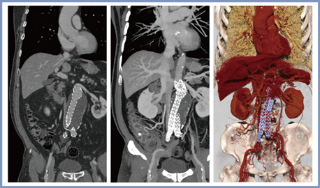 図3　腹部大動脈ステント留置後症例のSHRモードの画像