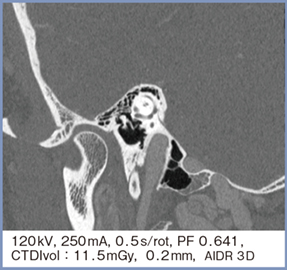図4　SHRモードのMPR画像による耳小骨の連結の描出