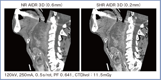図5　咽頭後壁がん症例におけるNRモードとSHRモードの比較（サジタル画像）