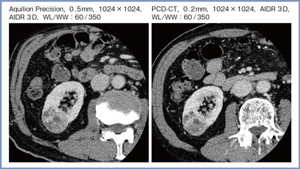 図6　右腎腫瘍におけるAquilion PrecisionとPCD-CTのthin slice画像の比較
