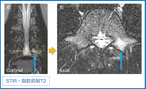 図2　MRIによる急性期分離の診断