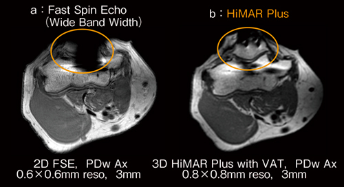図3　肘関節の金属インプラントにおけるfast spin echoとHiMAR Plusの画像比較