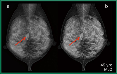 図3　合成2Dの臨床画像：右腫瘤（囊胞） a：FFDM　b：合成2D（HRモード）