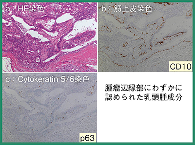 図4　左乳房の腫瘍辺縁部の免疫染色像