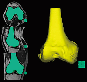 図2　MRIから“骨分離”機能を利用したサーフェス表示（Color STL）