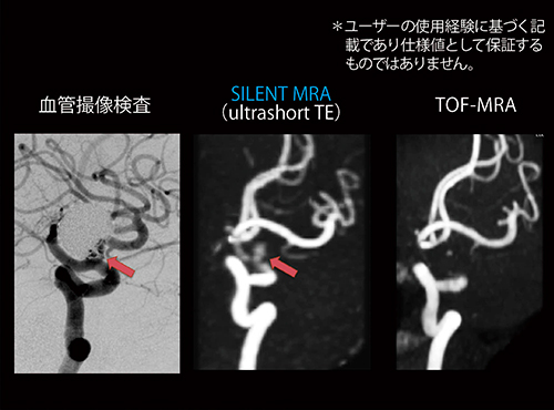 図3　SILENT MRA：動脈瘤 （画像ご提供：順天堂大学医学部附属順天堂医院・青木茂樹先生）