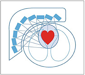 図2　心臓フォーカスコリメータ