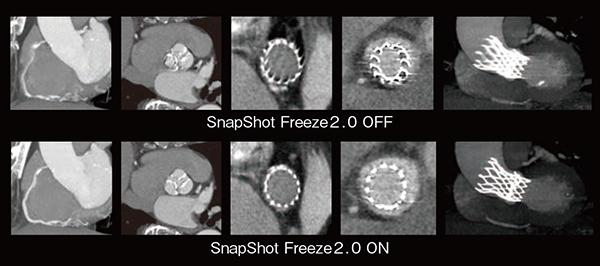 図3　SnapShot Freeze2.0 によるモーション抑制