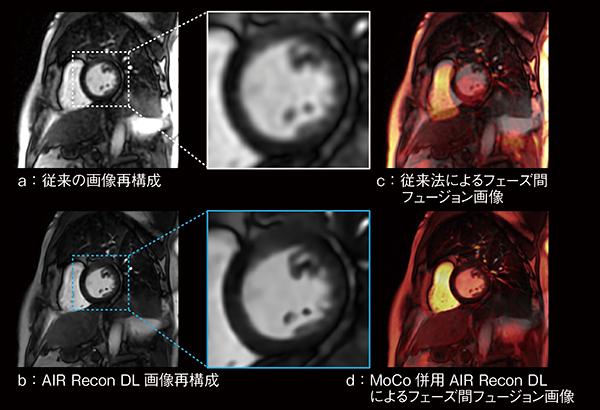 図5　パーフュージョン撮像における従来法とMoCo併用AIR Recon DLの比較 従来の画像再構成法（a）と比較すると，AIR Recon DL画像再構成ではSNRの改善と併せて乳頭筋が明瞭に確認される（b）。また，動き補正に関して従来法では，フェーズ間で位置ズレが生じている（c）が，MoCoにより呼吸による位置ズレが補正されている（d）。