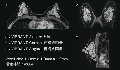 図1　AIR Recon DLを適用した乳腺dynamic画像例