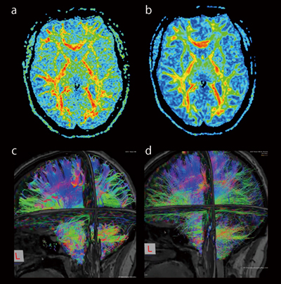 図4　脳の拡散テンソル画像