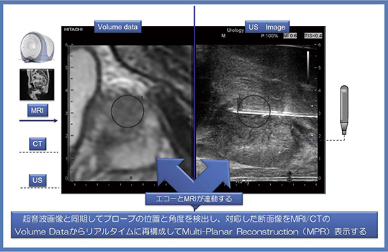 図1　RVSによる超音波画像とMRI画像の連動表示