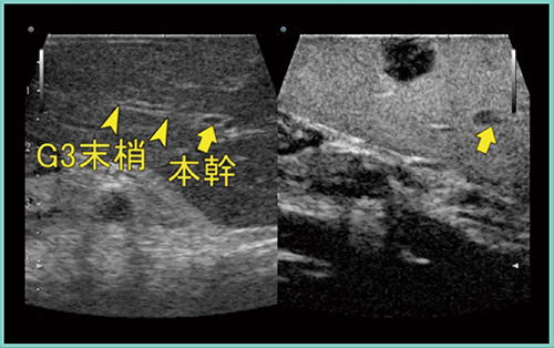 図2　症例1：肝転移切除（S3）の造影超音波画像