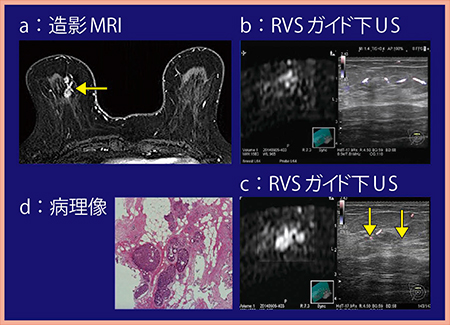 図4　症例3：MR画像を用いたRVSガイド下USにてDCISを認めた症例