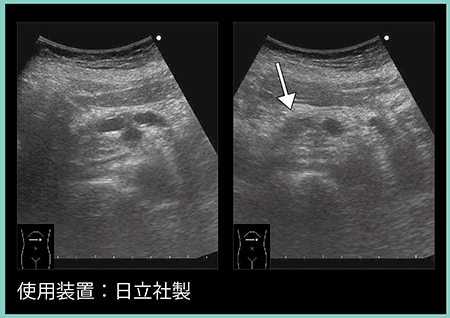 図1　症例1：早期膵癌の超音波画像
