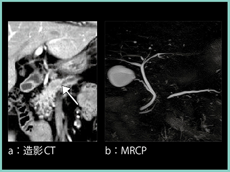 図6　症例3：検診発見膵癌の造影CTおよびMRCP画像